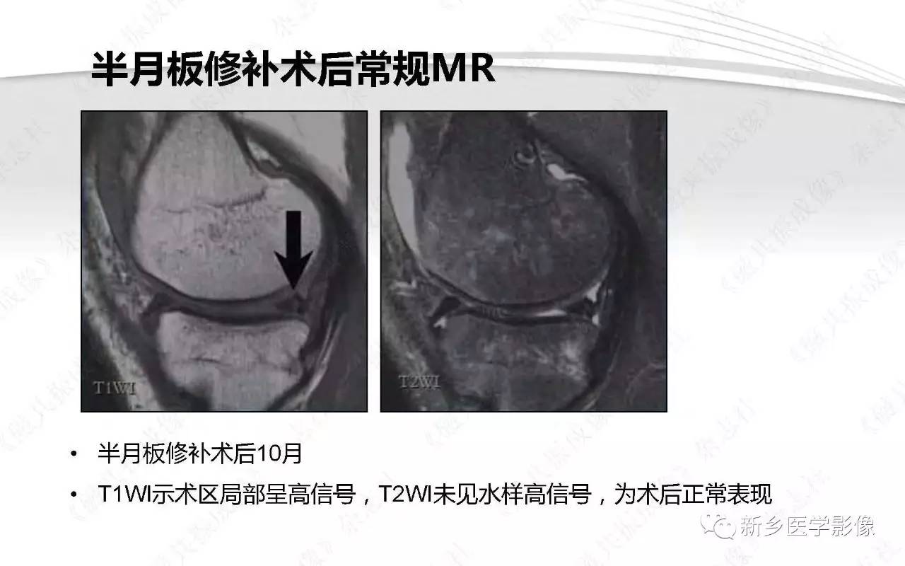 半月板损伤手术前后的MRI诊断