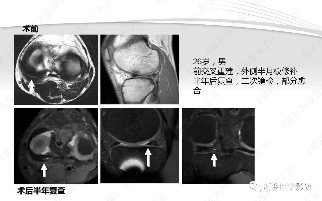 半月板损伤手术前后的MRI诊断