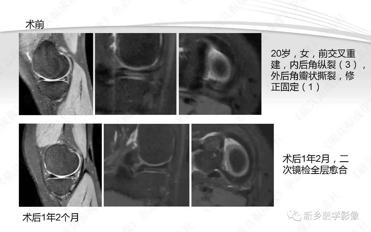 半月板损伤手术前后的MRI诊断