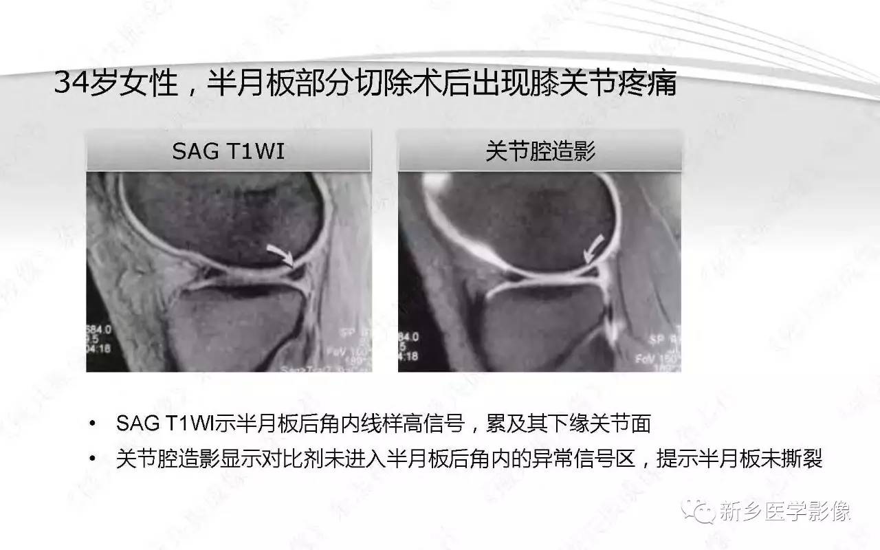 半月板损伤手术前后的MRI诊断