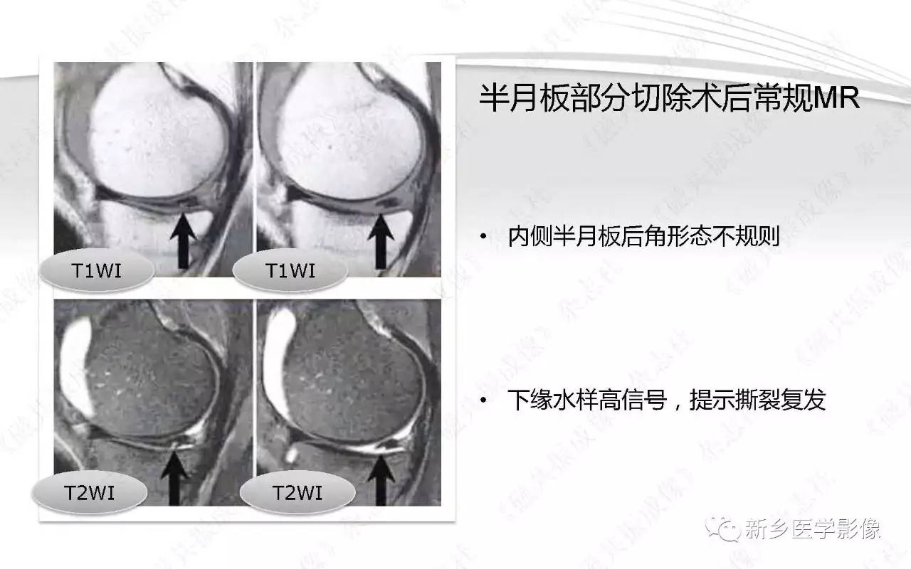 半月板损伤手术前后的MRI诊断