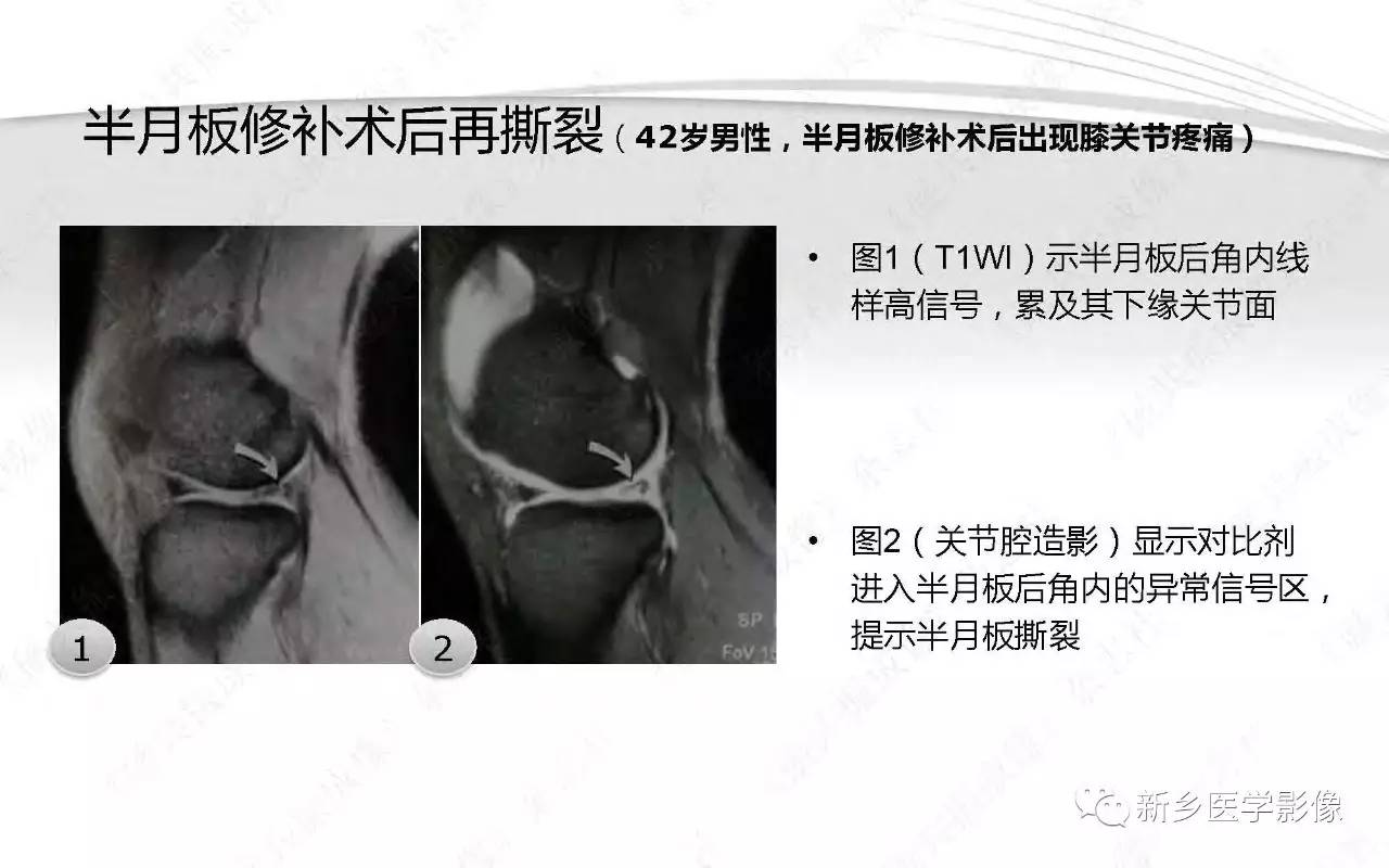 半月板损伤手术前后的MRI诊断