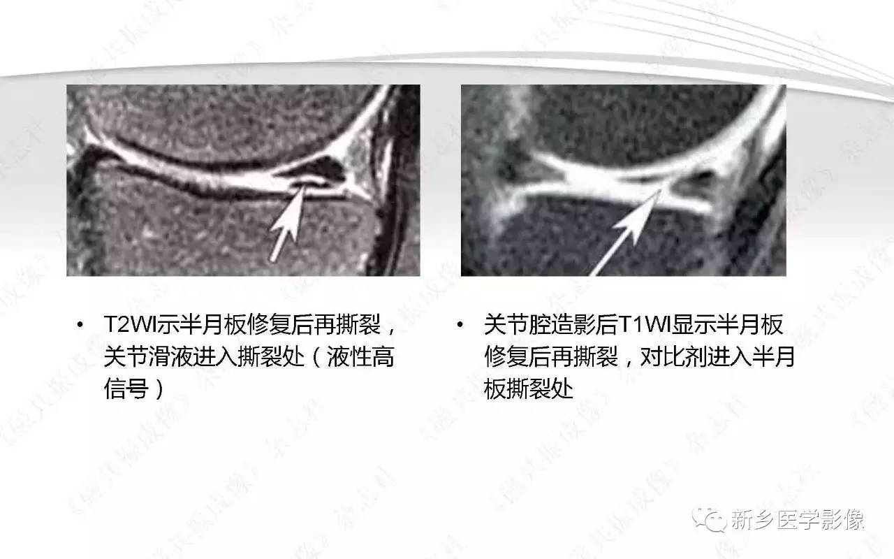 半月板损伤手术前后的MRI诊断