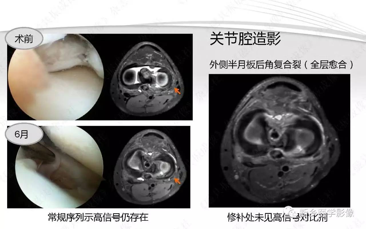 半月板损伤手术前后的MRI诊断