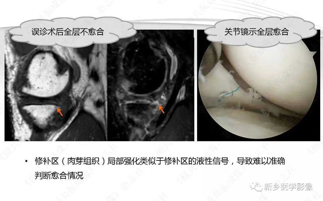 半月板损伤手术前后的MRI诊断