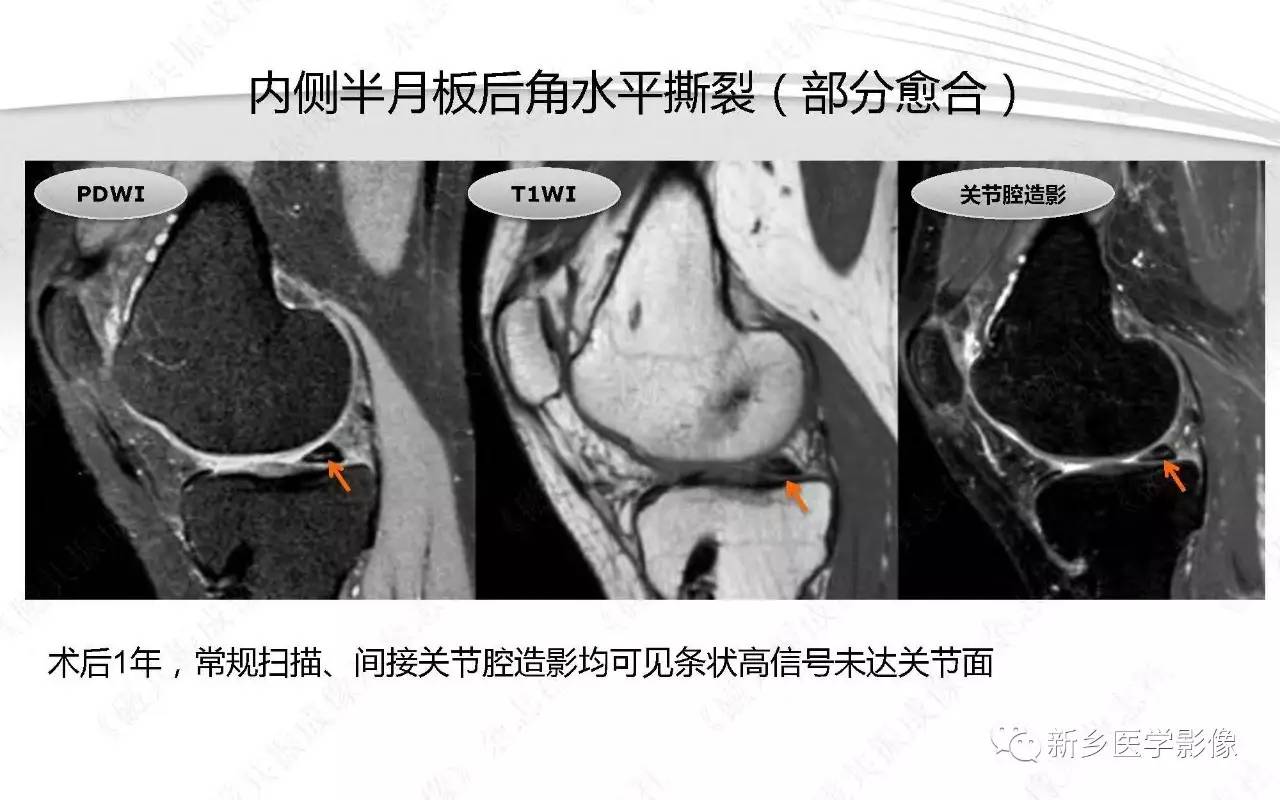 半月板损伤手术前后的MRI诊断