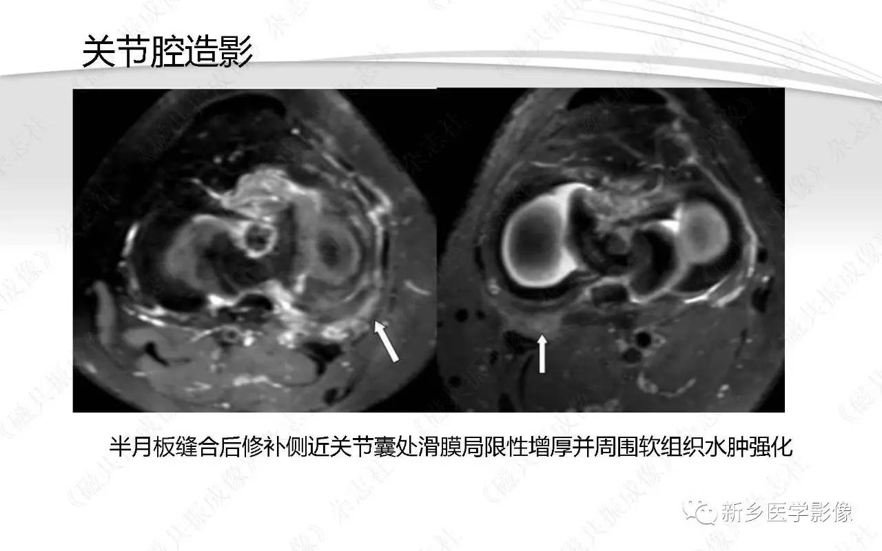 半月板损伤手术前后的MRI诊断