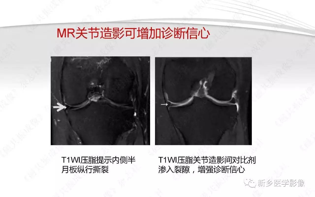 半月板损伤手术前后的MRI诊断