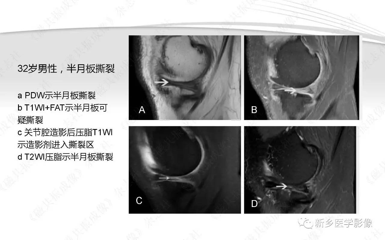 半月板损伤手术前后的MRI诊断
