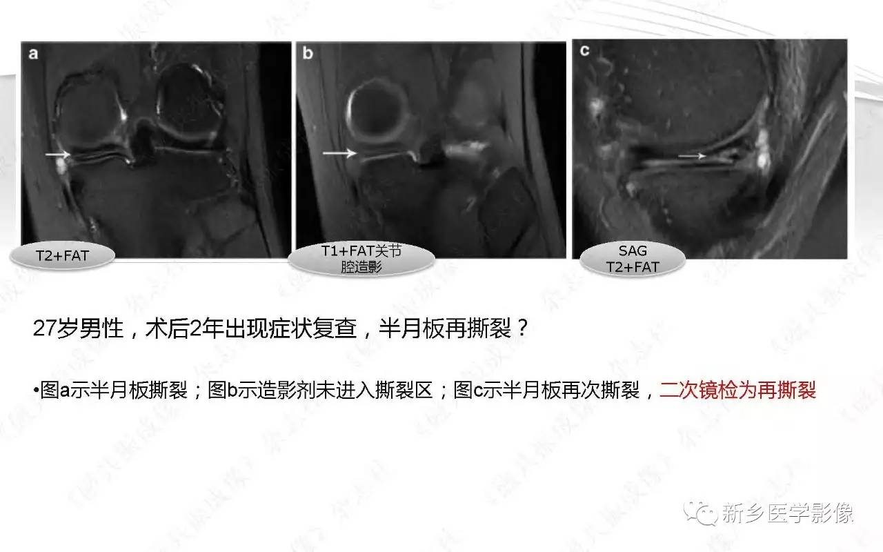 半月板损伤手术前后的MRI诊断