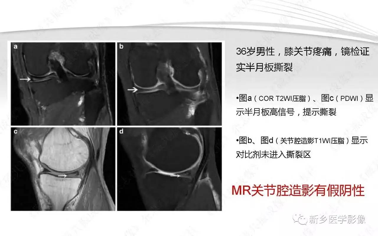 半月板损伤手术前后的MRI诊断