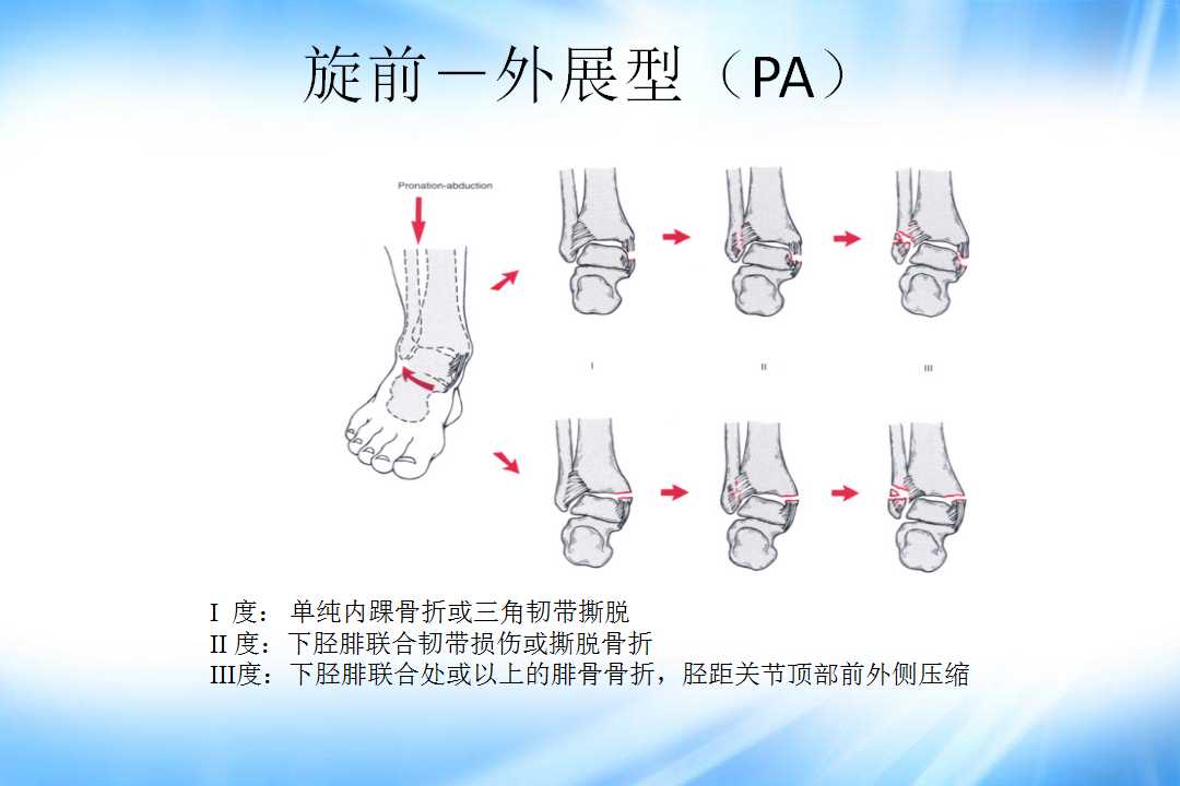 踝关节骨折的分型及治疗技巧