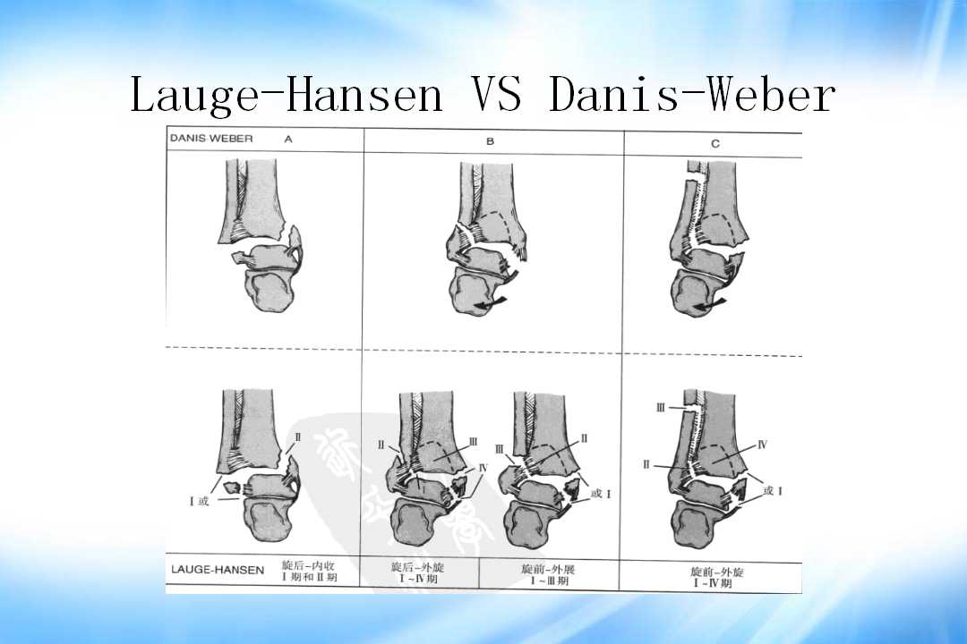 踝关节骨折的分型及治疗技巧