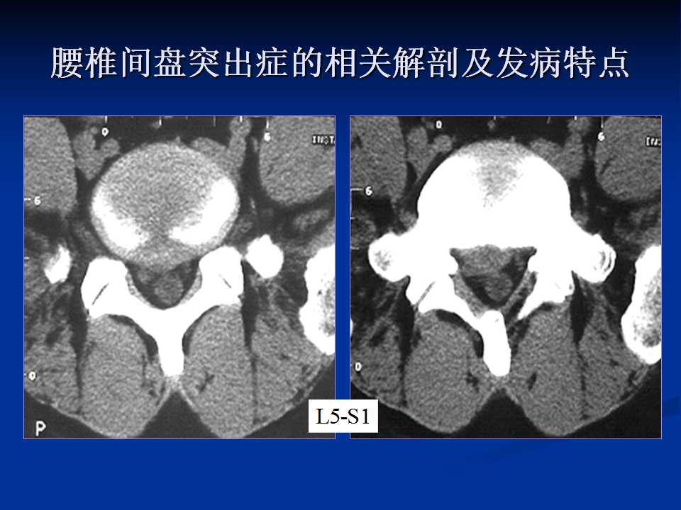 腰椎间盘突出症的鉴别诊断要点