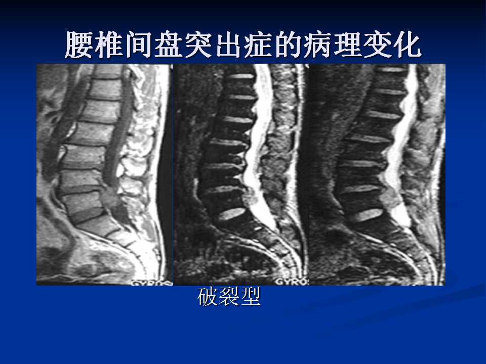 腰椎间盘突出症的鉴别诊断要点