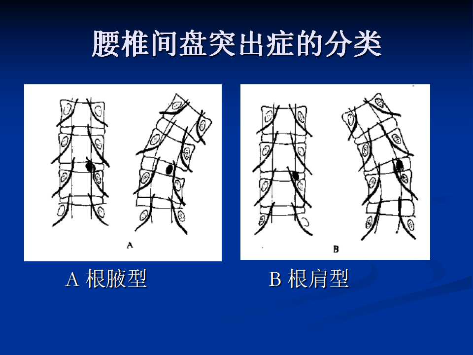 腰椎间盘突出症的鉴别诊断要点