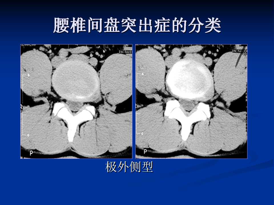 腰椎间盘突出症的鉴别诊断要点