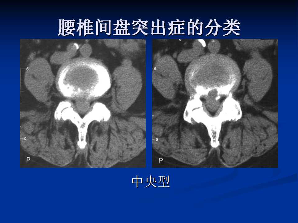 腰椎间盘突出症的鉴别诊断要点