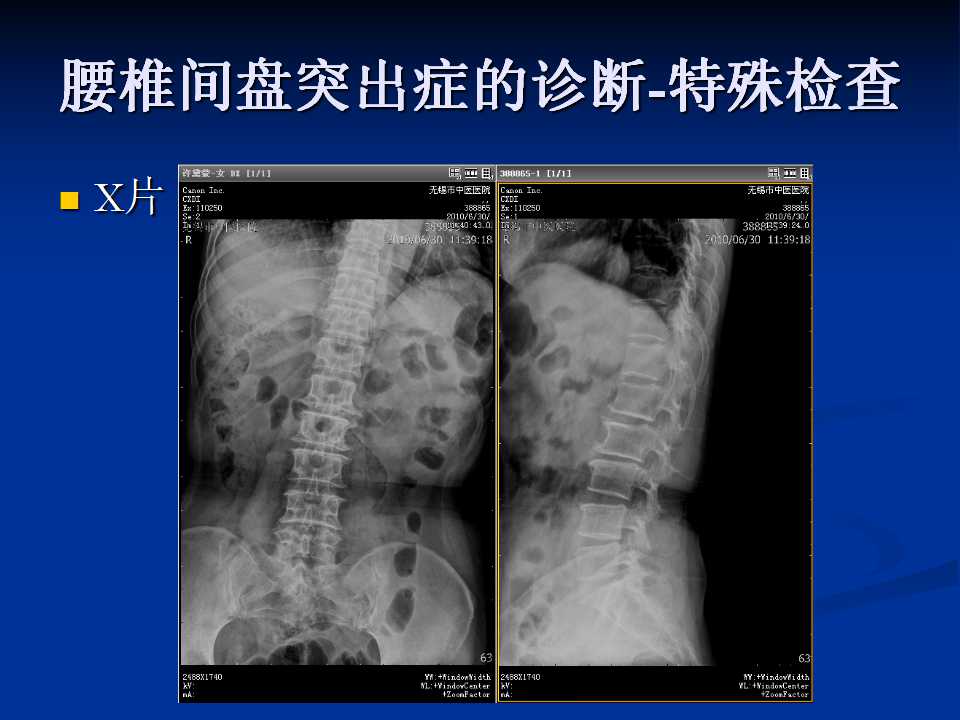 腰椎间盘突出症的鉴别诊断要点