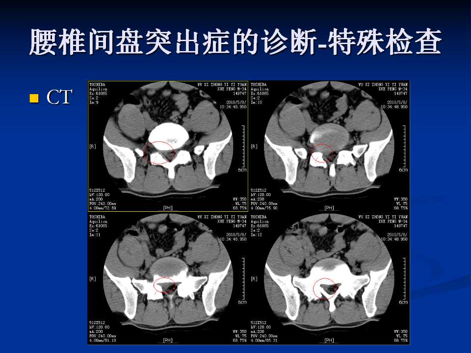 腰椎间盘突出症的鉴别诊断要点