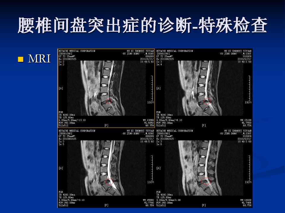 腰椎间盘突出症的鉴别诊断要点