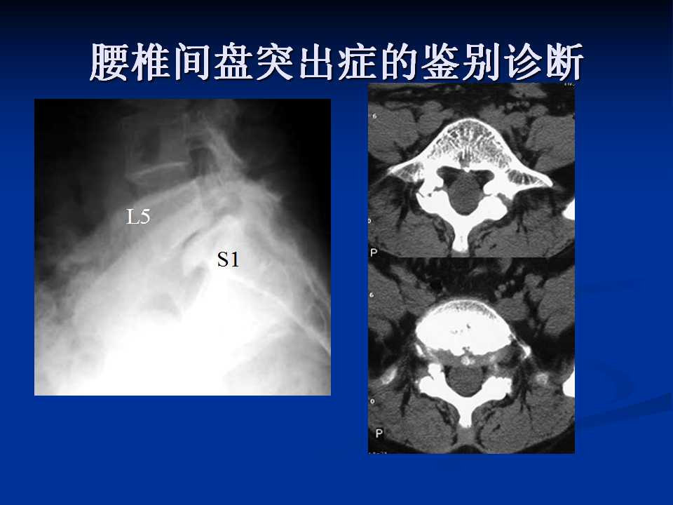 腰椎间盘突出症的鉴别诊断要点