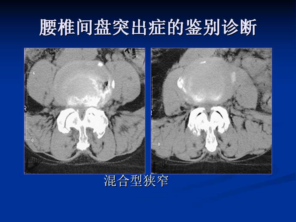 腰椎间盘突出症的鉴别诊断要点