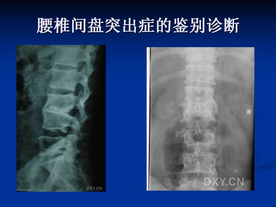 腰椎间盘突出症的鉴别诊断要点