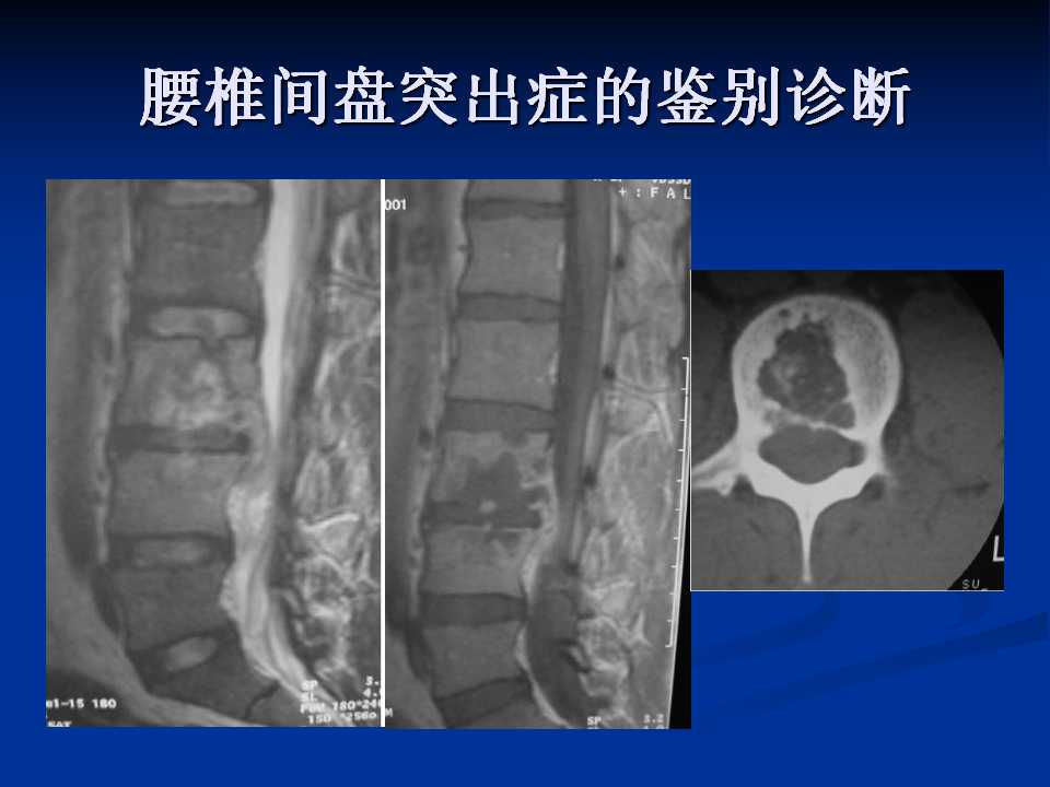 腰椎间盘突出症的鉴别诊断要点