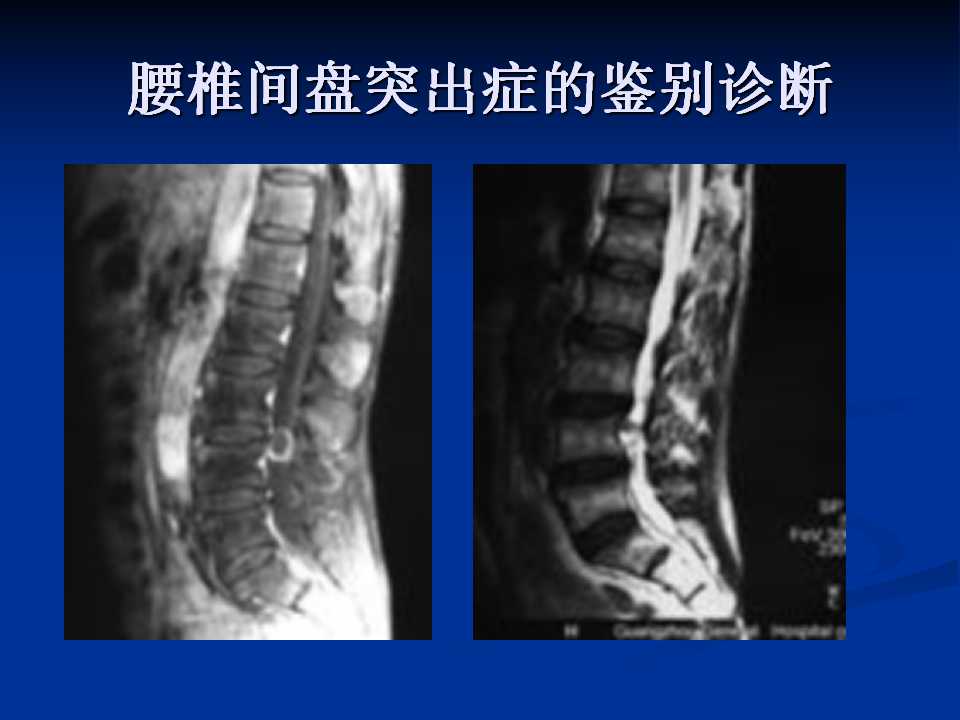 腰椎间盘突出症的鉴别诊断要点