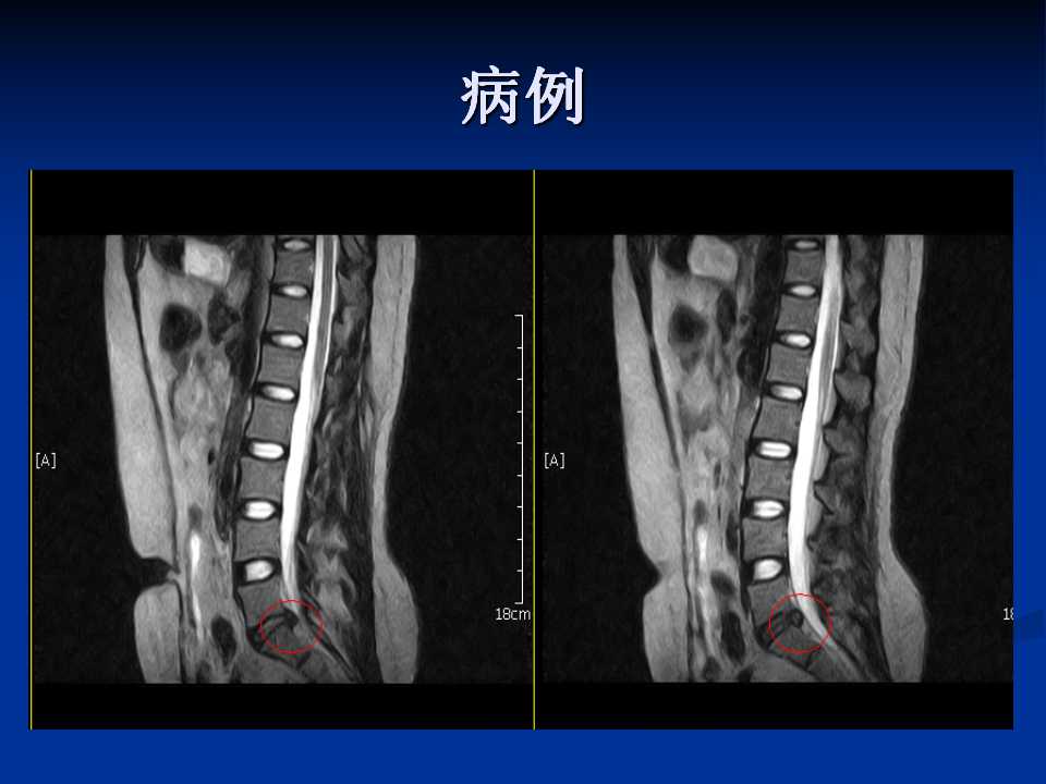 腰椎间盘突出症的鉴别诊断要点