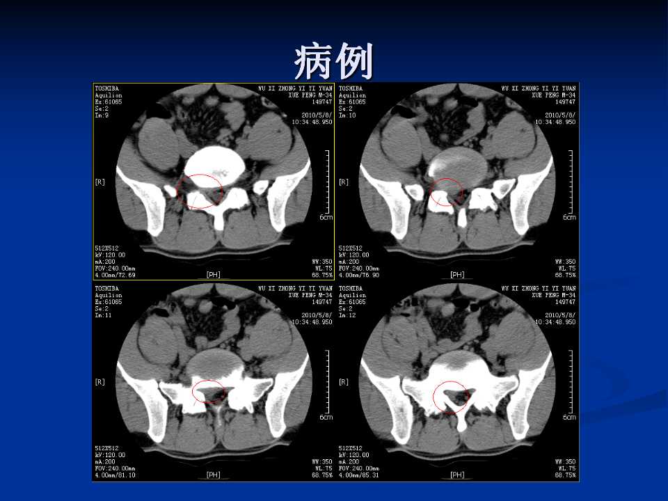 腰椎间盘突出症的鉴别诊断要点