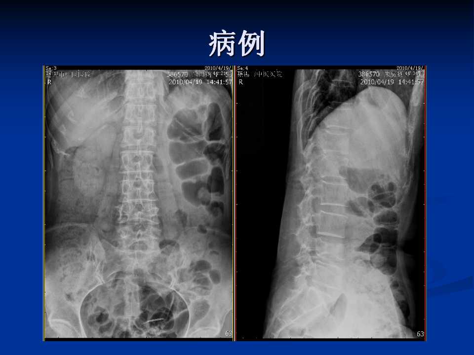 腰椎间盘突出症的鉴别诊断要点