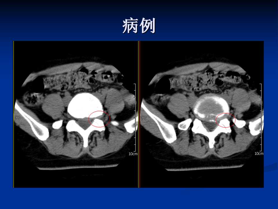 腰椎间盘突出症的鉴别诊断要点