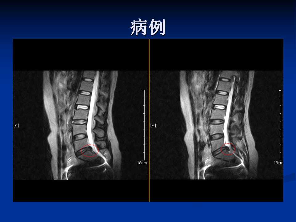 腰椎间盘突出症的鉴别诊断要点