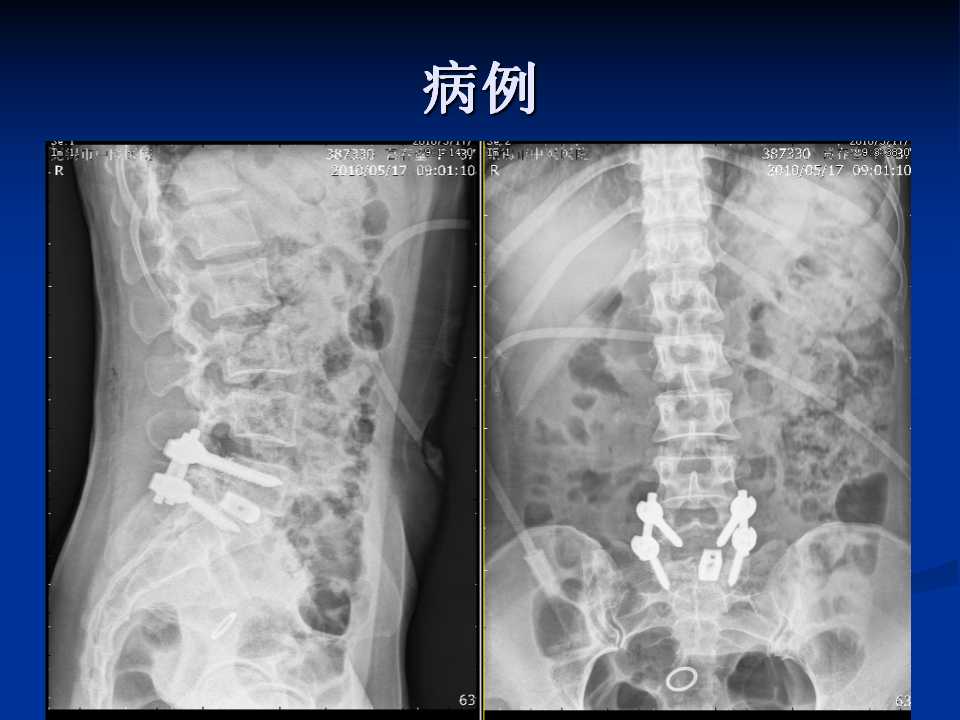 腰椎间盘突出症的鉴别诊断要点