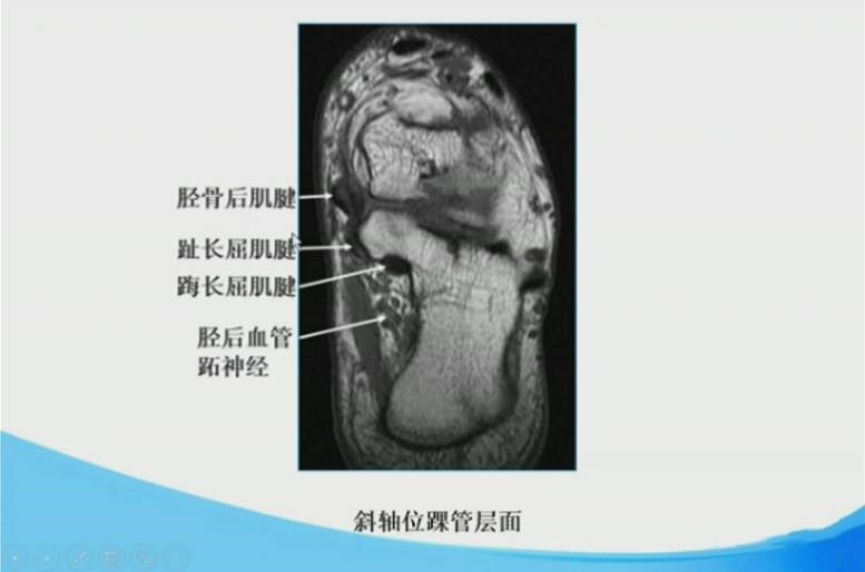足踝部MRI的解剖及诊断要点