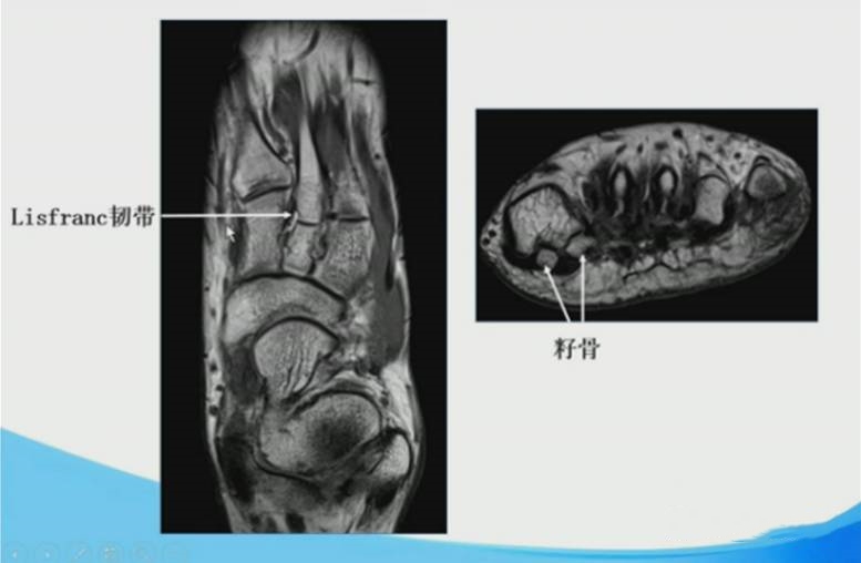 足踝部MRI的解剖及诊断要点