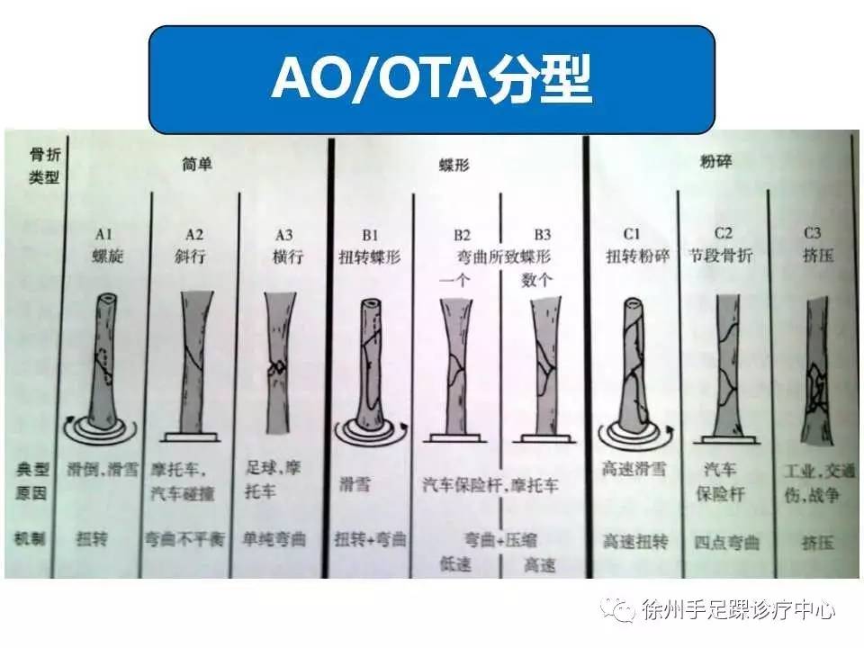 胫骨干骨折的诊断及治疗要点