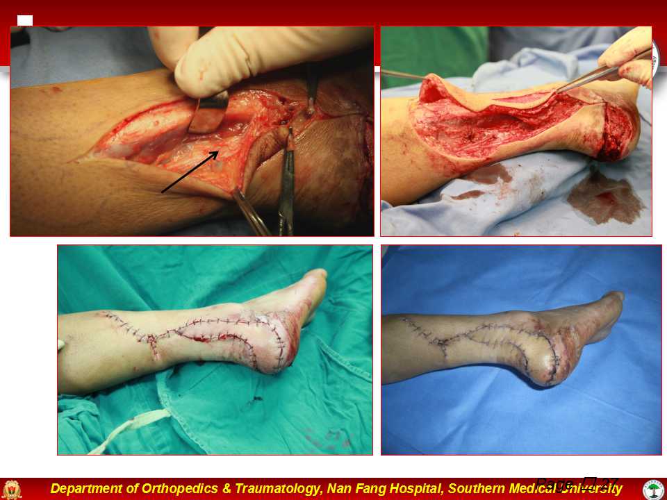 皮瓣移植修复足踝部创面技术