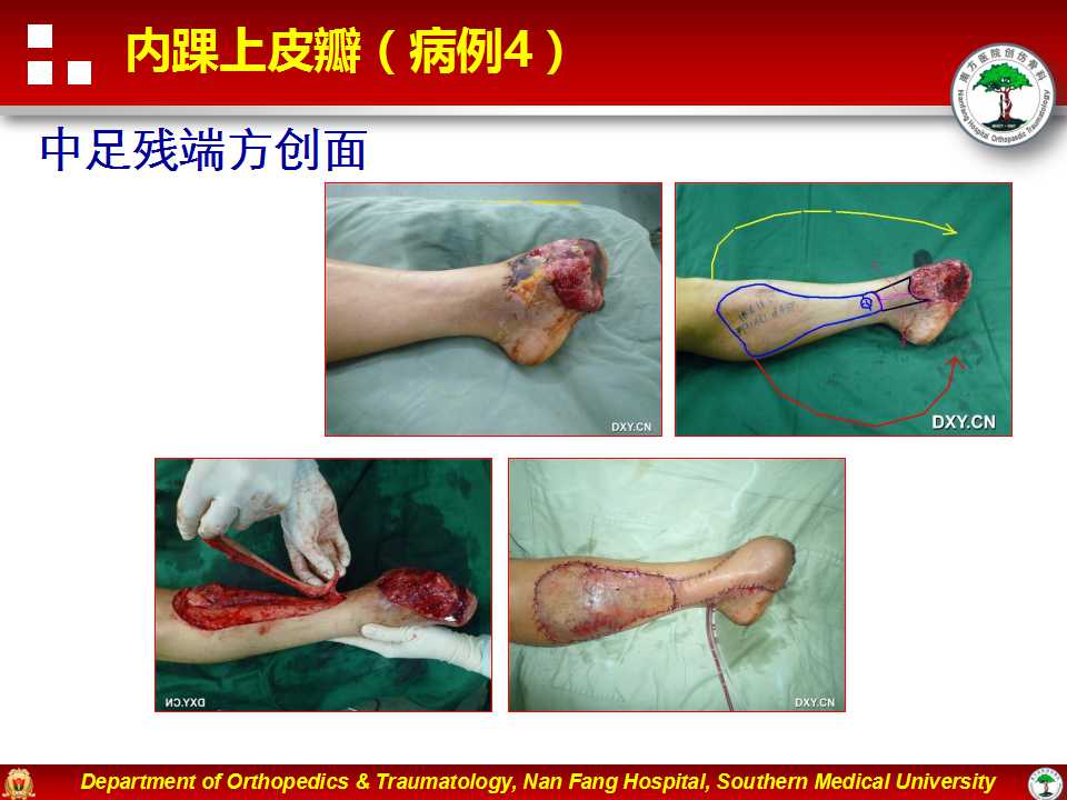 皮瓣移植修复足踝部创面技术