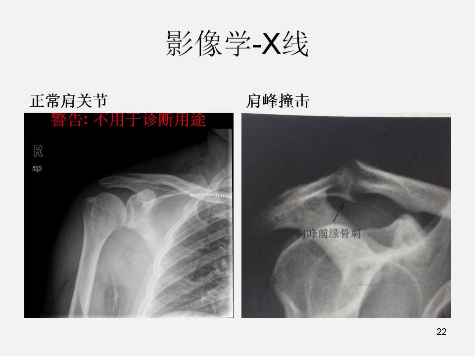 肩袖损伤的诊断与治疗技巧