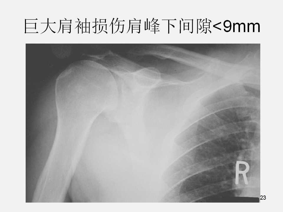 肩袖损伤的诊断与治疗技巧