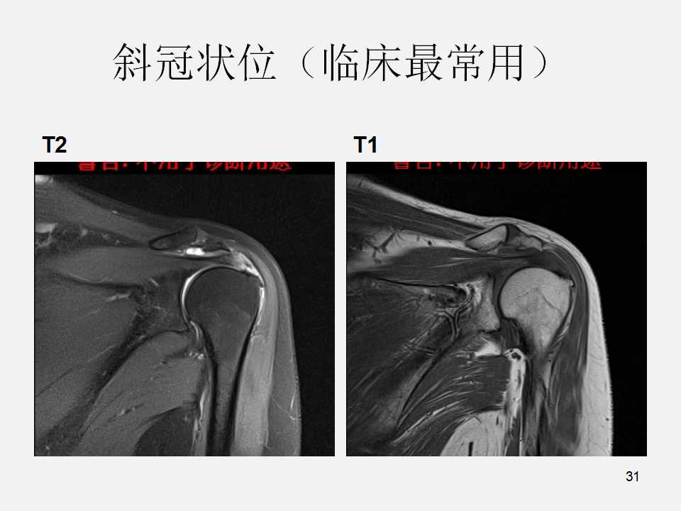 肩袖损伤的诊断与治疗技巧