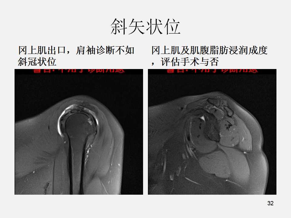 肩袖损伤的诊断与治疗技巧