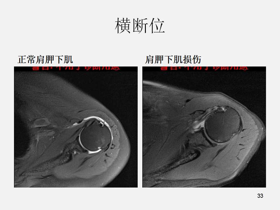 肩袖损伤的诊断与治疗技巧