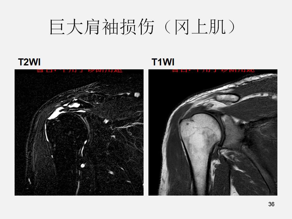 肩袖损伤的诊断与治疗技巧