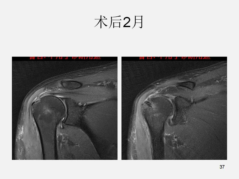 肩袖损伤的诊断与治疗技巧