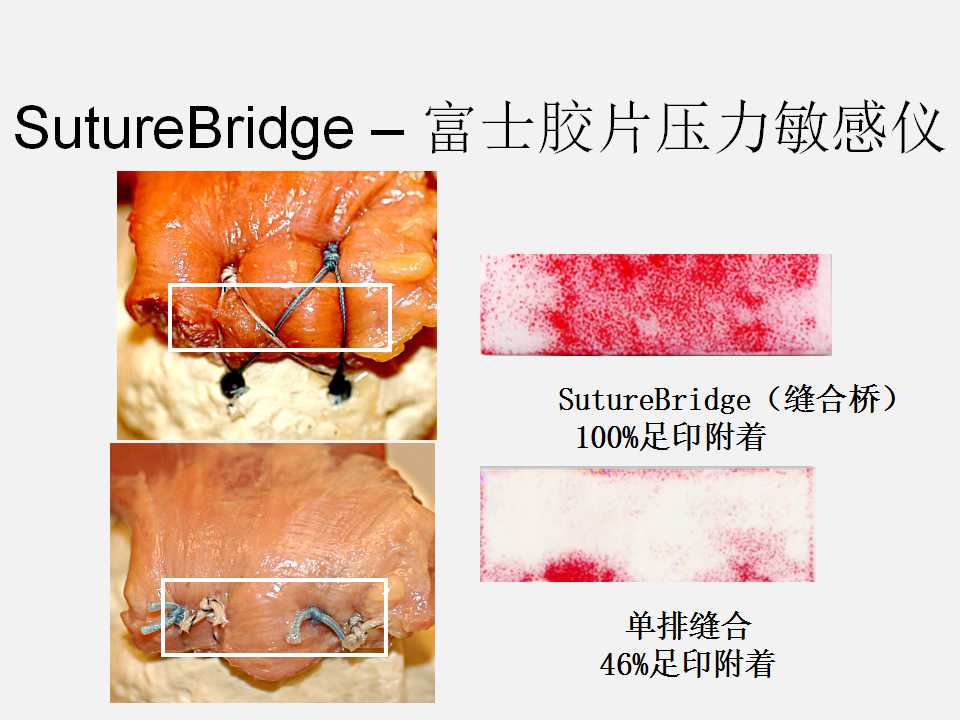 肩袖损伤的诊断与治疗技巧