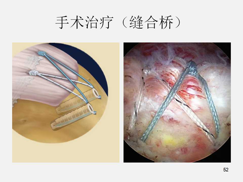 肩袖损伤的诊断与治疗技巧